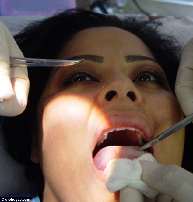 'miracle' patch sewn onto tongue for weight-loss